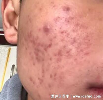 暗瘡圖片是什么樣子，暗瘡和痤瘡有區別(不形成膿包)