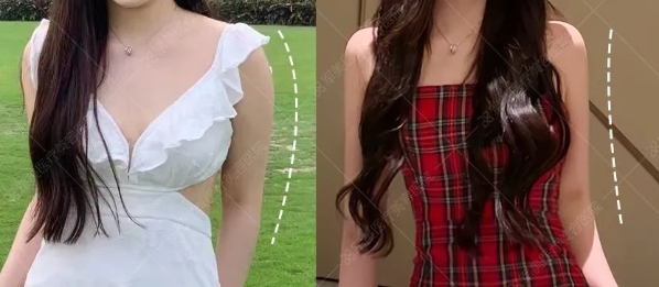 想吸脂后美美穿比基尼，這3大細節(jié)要注意