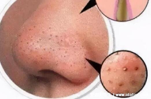 暗瘡圖片是什么樣子，暗瘡和痤瘡有區別(不形成膿包)