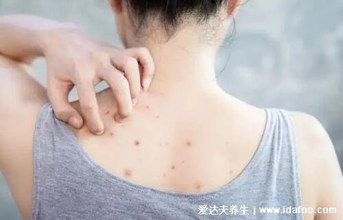 暗瘡圖片是什么樣子，暗瘡和痤瘡有區別(不形成膿包)