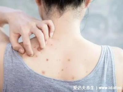 暗瘡圖片是什么樣子，暗瘡和痤瘡有區別(不形成膿包)