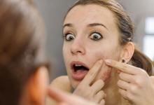 教你2個天然秘方 解決痘痘的煩惱