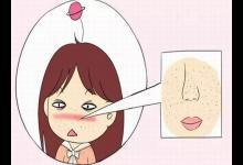 怎么才能告別“草莓鼻”變回小仙女?