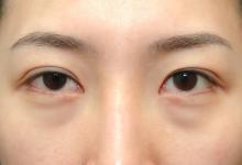  為什么會(huì)出現(xiàn)眼袋？怎樣有效去眼袋？