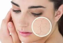 女性皮膚干燥怎么辦? 如何改善?