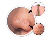 鼻子上的黑頭如何去除 幾個(gè)簡易方法請收好