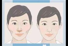 警惕!削骨手術(shù)易出現(xiàn)3種并發(fā)癥