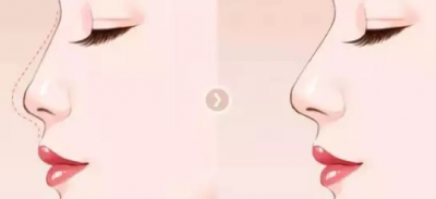 關于『 萌芽仿生綜合隆鼻術』你想知道的都在這里!