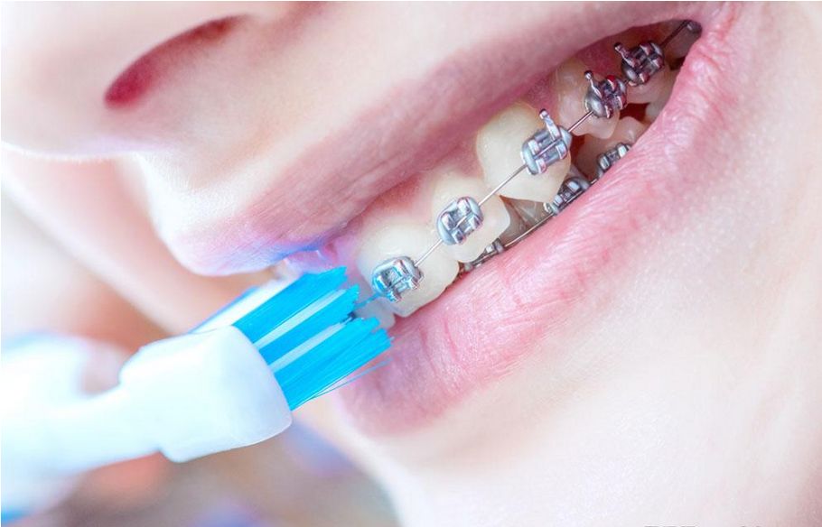 口腔正畸 不只是變美