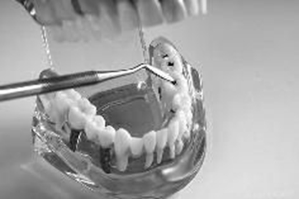 牙齒漂白前先治牙病-易網健康<a href=http://www.xllyou.com/jkys/ target=_blank class=infotextkey>養生</a>網 牙齒漂白前先治牙病