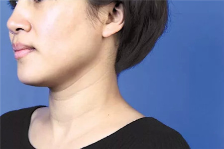 魚尾紋形成的原因是什么?怎樣才能有效去除-易網健康<a href=http://www.xllyou.com/jkys/ target=_blank class=infotextkey>養生</a>網 魚尾紋形成的原因是什么?怎樣才能有效去除