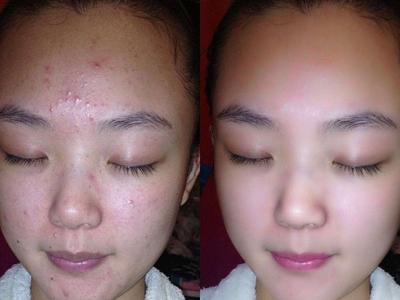 女性長(zhǎng)膿包型痤瘡怎么治理,紅腫膿皰護(hù)理不當(dāng)容易留痘疤