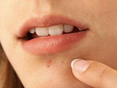 面部痤瘡下巴長痘,鼻子長黑頭,最佳的治療方式是選擇它