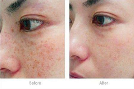 女性激光祛斑會反彈嗎,醫美后五個注意事項-易網健康<a href=http://www.xllyou.com/jkys/ target=_blank class=infotextkey>養生</a>網 女性激光祛斑會反彈嗎,醫美后五個注意事項