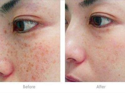 女性激光祛斑會反彈嗎，醫美后五個注意事項