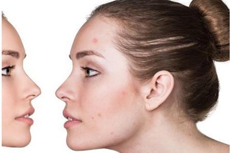 痘痘長在嘴角周圍是怎么一回事,女性清痘只需三招-易網<a href=http://www.xllyou.com/ target=_blank class=infotextkey>健康養生</a>網 痘痘長在嘴角周圍是怎么一回事,女性清痘只需三招