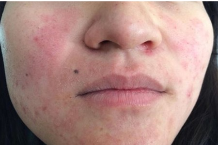 女性患毛囊炎的癥狀,面部多發(fā)如何治療-易網(wǎng)<a href=http://www.xllyou.com/ target=_blank class=infotextkey>健康養(yǎng)生</a>網(wǎng) 女性患毛囊炎的癥狀,面部多發(fā)如何治療