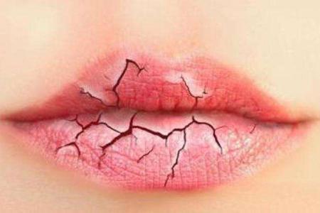 嘴唇干燥脫皮怎么辦? 教你5招輕松應(yīng)對-易網(wǎng)健康<a href=http://www.xllyou.com/jkys/ target=_blank class=infotextkey>養(yǎng)生</a>網(wǎng) 嘴唇干燥脫皮怎么辦? 教你5招輕松應(yīng)對