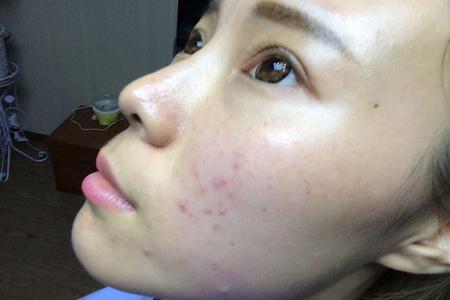 臉上起了密密麻麻的小疙瘩怎么辦，五個方法恢復光滑皮膚