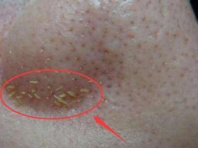 鼻子上擠出來的白色東西是什么？如何正確去除