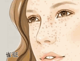 為什么皮膚白的容易長斑？長斑該如何護理？