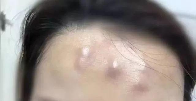 女子注射去皺 額頭竟冒出5個“犄角”-易網健康<a href=http://www.xllyou.com/jkys/ target=_blank class=infotextkey>養生</a>網 女子注射去皺 額頭竟冒出5個“犄角”