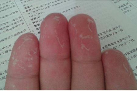 手指脫皮的四個原因，教你快速恢復方法治療手脫皮
