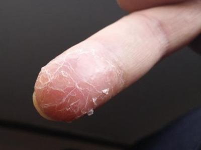 手指脫皮的四個(gè)原因,教你快速恢復(fù)方法治療手脫皮
