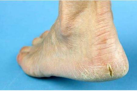 腳后跟干裂起硬皮的原因,女性護理腳部肌膚的正確方法-易網<a href=http://www.xllyou.com/ target=_blank class=infotextkey>健康養生</a>網 腳后跟干裂起硬皮的原因,女性護理腳部肌膚的正確方法