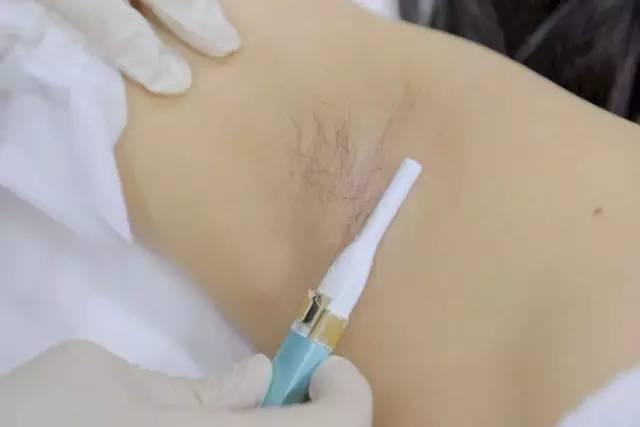 腋下脫毛后出汗多有異味怎么回事?腋下脫毛護(hù)理方法分享-易網(wǎng)健康<a href=http://www.xllyou.com/jkys/ target=_blank class=infotextkey>養(yǎng)生</a>網(wǎng) 腋下脫毛后出汗多有異味怎么回事?腋下脫毛護(hù)理方法分享