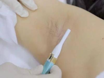 腋下脫毛后出汗多有異味怎么回事?腋下脫毛護理方法分享