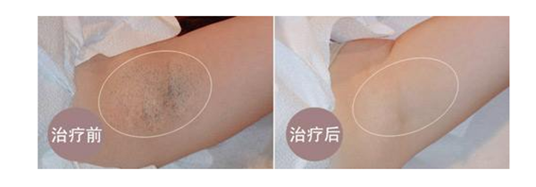 脫毛膏可以脫陰部毛嗎?什么樣的脫毛方式效果最好?