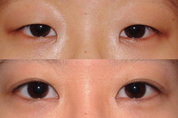 雙眼皮貼什么形狀好用?如何使用?-易網(wǎng)健康<a href=http://www.xllyou.com/jkys/ target=_blank class=infotextkey>養(yǎng)生</a>網(wǎng) 雙眼皮貼什么形狀好用?如何使用?