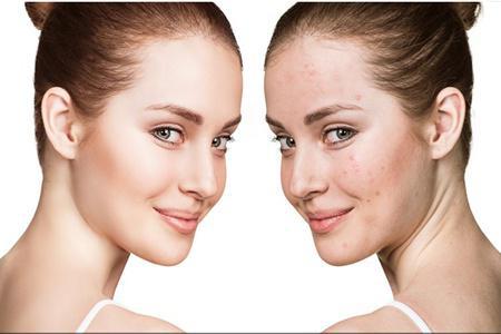 女生30歲臉上長痘痘的原因,長痘痘效果最佳的治療方法-易網<a href=http://www.xllyou.com/ target=_blank class=infotextkey>健康養生</a>網 女生30歲臉上長痘痘的原因,長痘痘效果最佳的治療方法