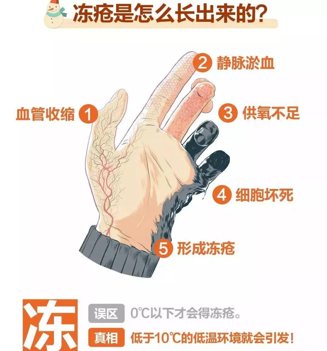 冬天天氣冷長凍瘡怎么辦?6個小妙招教給你-易網健康<a href=http://www.xllyou.com/jkys/ target=_blank class=infotextkey>養生</a>網 冬天天氣冷長凍瘡怎么辦?6個小妙招教給你