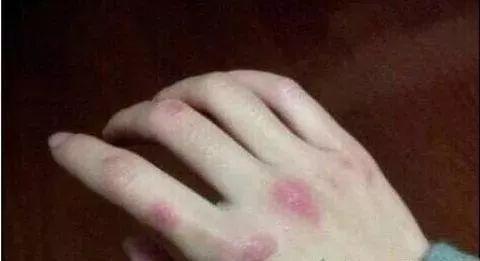 冬天天氣冷長凍瘡怎么辦?6個小妙招教給你-易網健康養生網 冬天天氣冷長凍瘡怎么辦?6個小妙招教給你