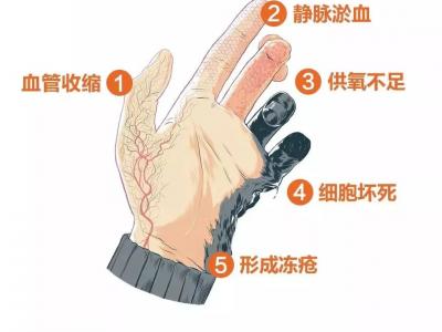 冬天天氣冷長凍瘡怎么辦?6個小妙招教給你