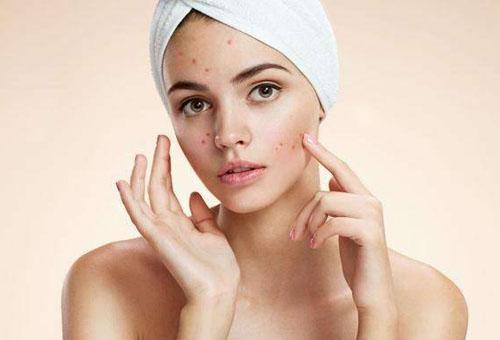 面部頻繁起痘是怎么回事?這4個原因要注意-易網健康養生網 面部頻繁起痘是怎么回事?這4個原因要注意