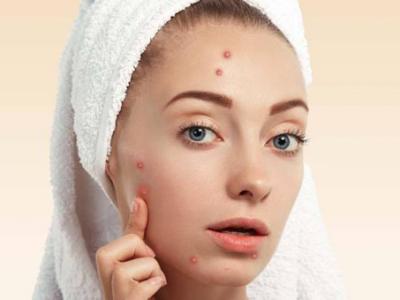 臉上的痘坑能去除嗎 簡(jiǎn)單9招讓你擺脫“月球臉”