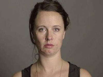 嘴巴周圍長痘的原因,困擾女生的痘痘問題四招解決