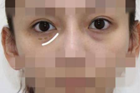 怎樣祛眼袋，讓眼袋消失無蹤的有效妙招