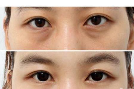 怎樣祛眼袋，讓眼袋消失無蹤的有效妙招