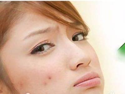 膿包型痤瘡的護理方法,教你六招修復皮膚