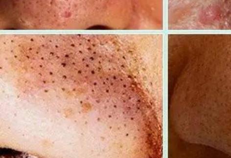 去黑頭粉刺妙招屢試有好效果 什么樣的膚質容易有黑頭-易網健康<a href=http://www.xllyou.com/jkys/ target=_blank class=infotextkey>養生</a>網 去黑頭粉刺妙招屢試有好效果 什么樣的膚質容易有黑頭