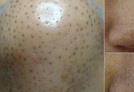 去黑頭粉刺妙招屢試有好效果 什么樣的膚質容易有黑頭-易網健康養生網 去黑頭粉刺妙招屢試有好效果 什么樣的膚質容易有黑頭