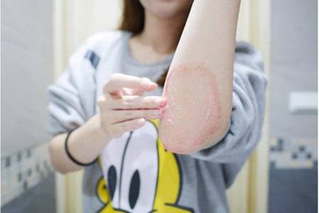 雞皮膚治療多少錢,最省錢最好的雞皮治療方法-易網(wǎng)健康養(yǎng)生網(wǎng) 雞皮膚治療多少錢,最省錢最好的雞皮治療方法