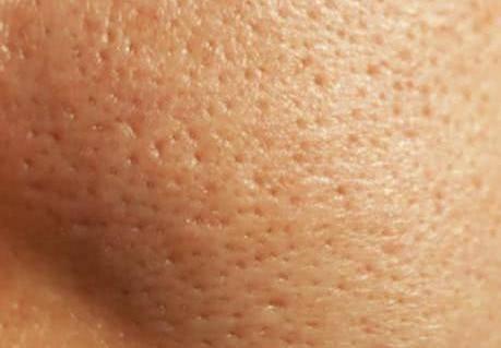 毛孔粗大怎么辦 針對不同情況的毛孔粗大該如何護(hù)膚?-易網(wǎng)<a href=http://www.xllyou.com/ target=_blank class=infotextkey>健康養(yǎng)生</a>網(wǎng) 毛孔粗大怎么辦 針對不同情況的毛孔粗大該如何護(hù)膚?