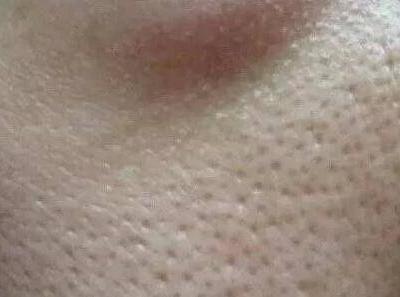 毛孔粗大怎么辦 針對不同情況的毛孔粗大該如何護膚?
