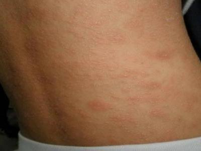 玫瑰糠疹皮膚病怎么引起的,治療方法中忌口這五種食物