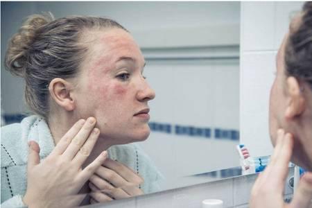 皮膚過(guò)敏紅癢怎么辦，過(guò)敏皮膚的日常護(hù)理五大方法